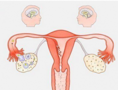 什么是多囊性卵巢囊肿